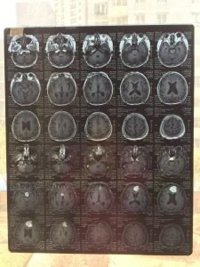 Post Mri Of Brain Tumor   X