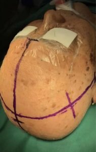 Brain Tumor  X
