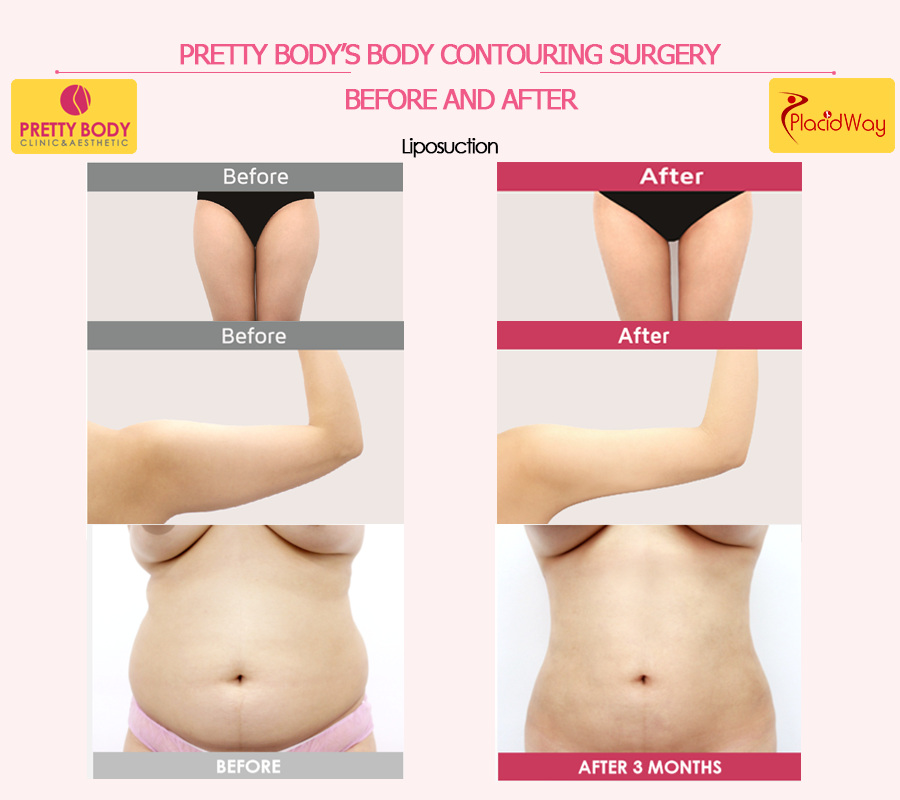 Before & After Liposuction in Seoul, South Korea