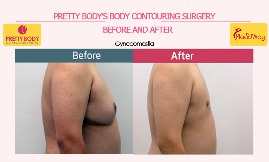 Before & After gynecomastia in Seoul, South Korea