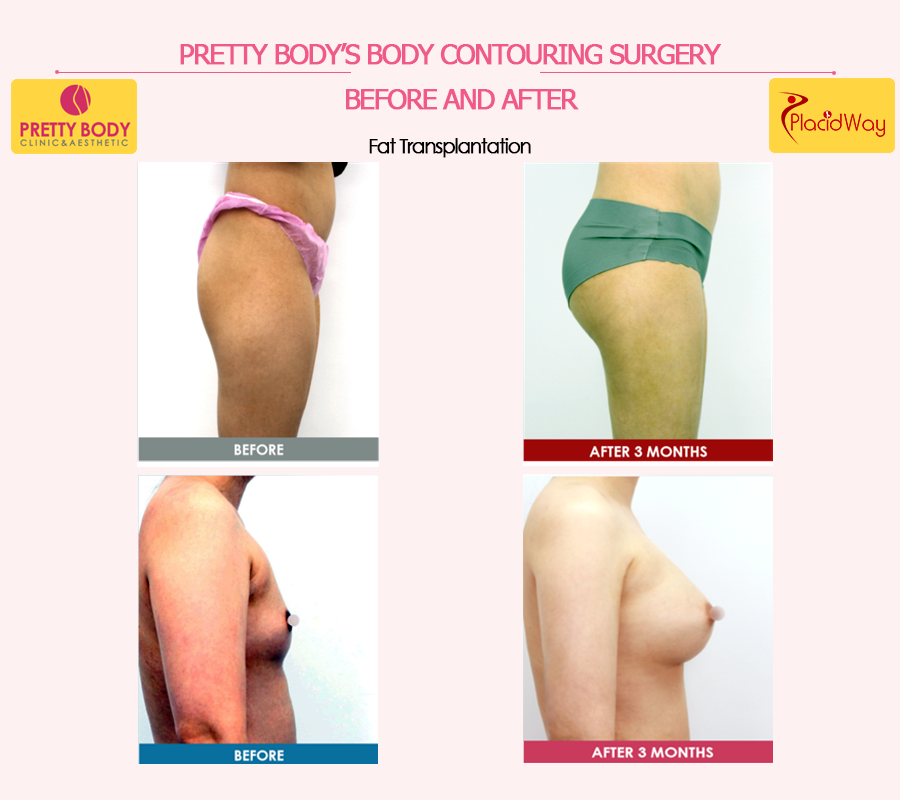 Fat Transplantation Before and After in Seoul, South Korea