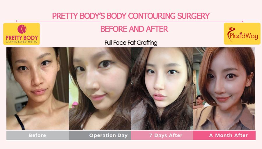 Before & After Full Face Fat Grafting in Seoul, South Korea