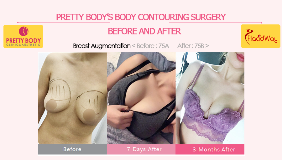 Before and After Breast Augmentation in Pretty Body Clinic, Seoul, South Korea
