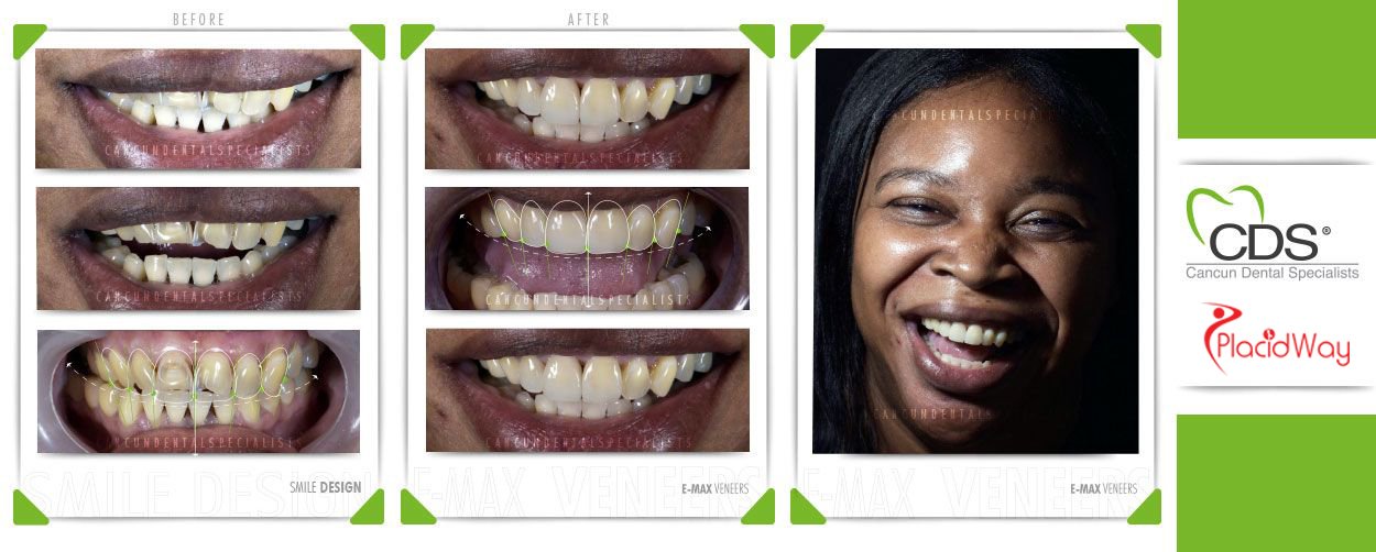 Before and After Emax Veneers in Cancun, Mexico