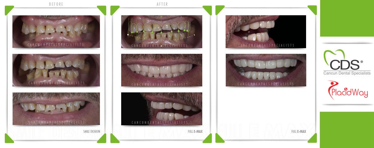 Before and After Dental Full Emax Veneers in Cancun, Mexico