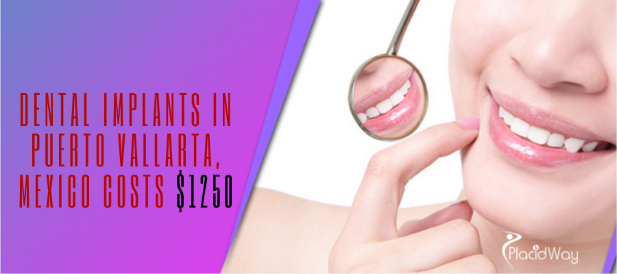 Dental Implants in Puerto Vallarta, Mexico Cost