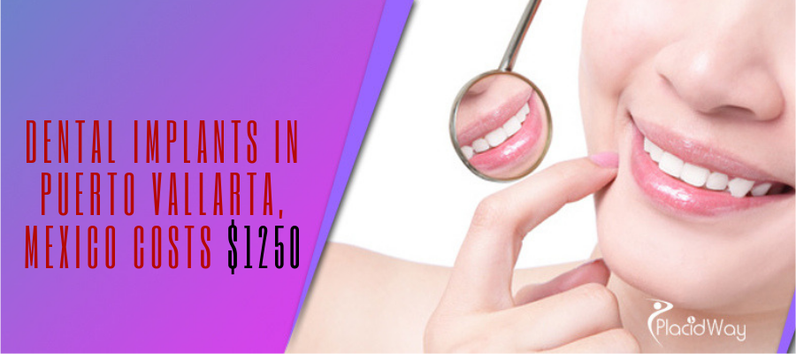 Implantes Dentales en Puerto Vallarta, Mexico Costo