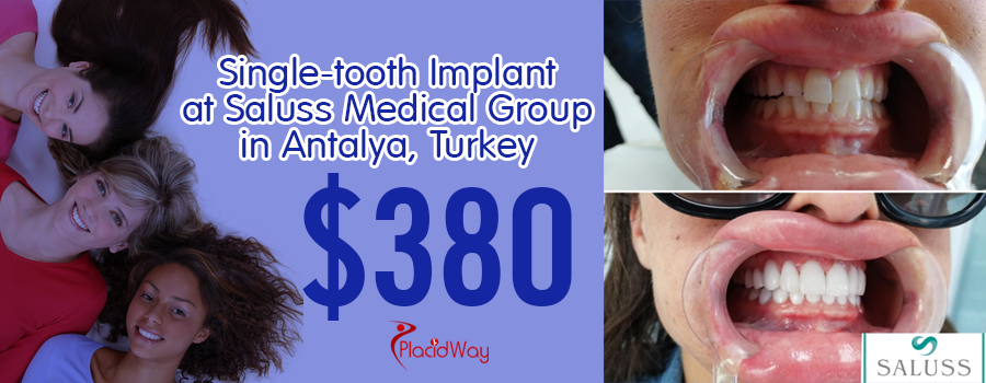 Single-tooth Implant by Saluss Medical Group in Antalya, Turkey Price