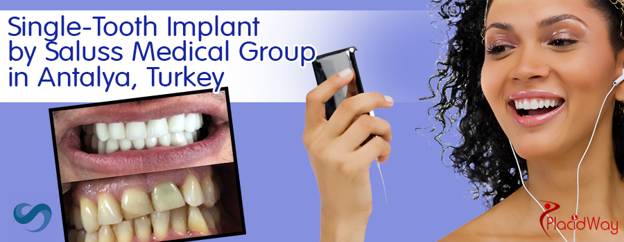 Single-tooth Implant by Saluss Medical Group in Antalya, Turkey