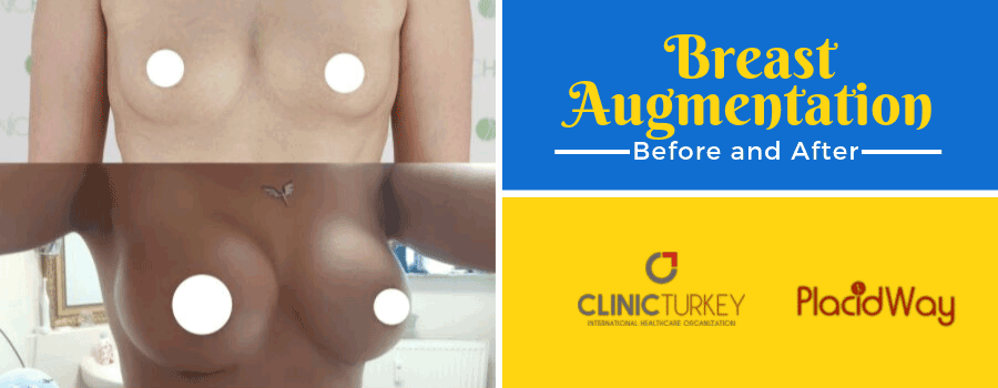 Breast Augmentation Before and After, Izmir, Turkey