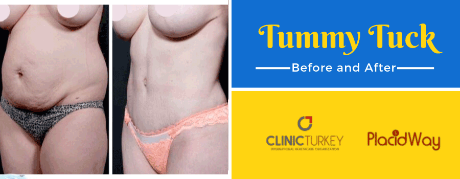 Before and After Tummy Tuck Before in Turkey