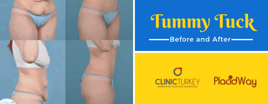 Before and After Abdominoplasty in Turkey