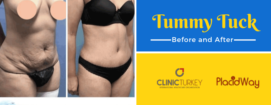 Before and After Abdominoplasty in Izmir, Turkey
