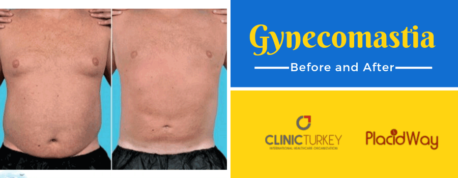 Gynecomastia Before and After, Izmir, Turkey