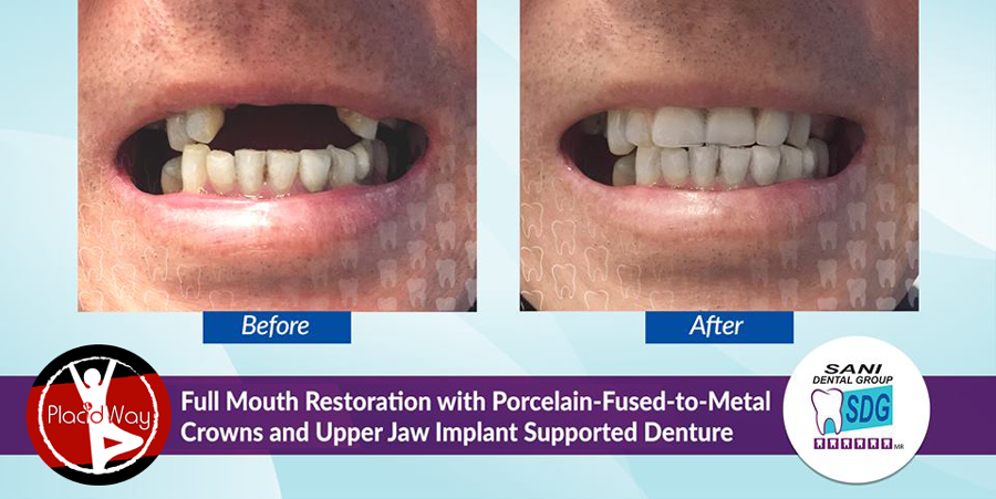 Before and After Full Mouth Reconstruction in Sani Dental Group, Los Algodones, Mexico