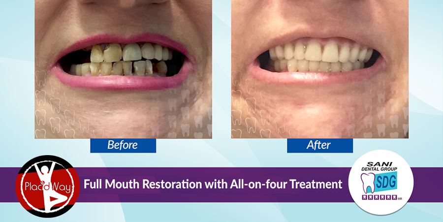 Patient Testimonial Before and After Full Mouth Reconstruction in Sani Dental Group, Los Algodones, Mexico