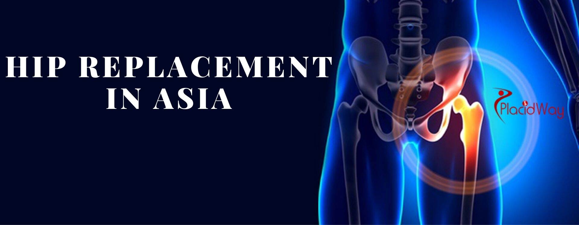 Hip Replacement in Asia
