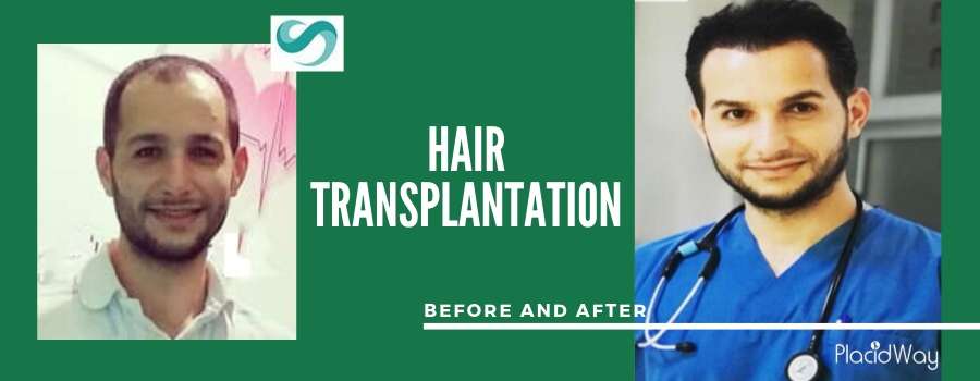 Hair Transplant Before and After, Antalya, Turkey
