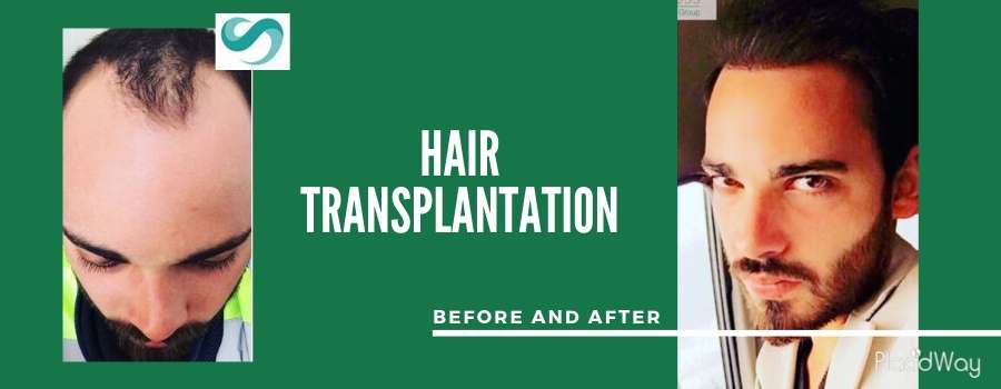 Patient Testimonial Hair Restoration Before and After, Antalya, Turkey