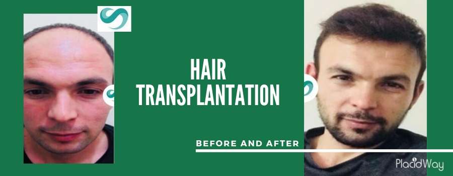 Patient Testimonial Hair Restoration Before and After, Antalya, Turkey