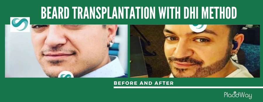 Patient Testimonial Beard Transplantation Before and After, Antalya, Turkey