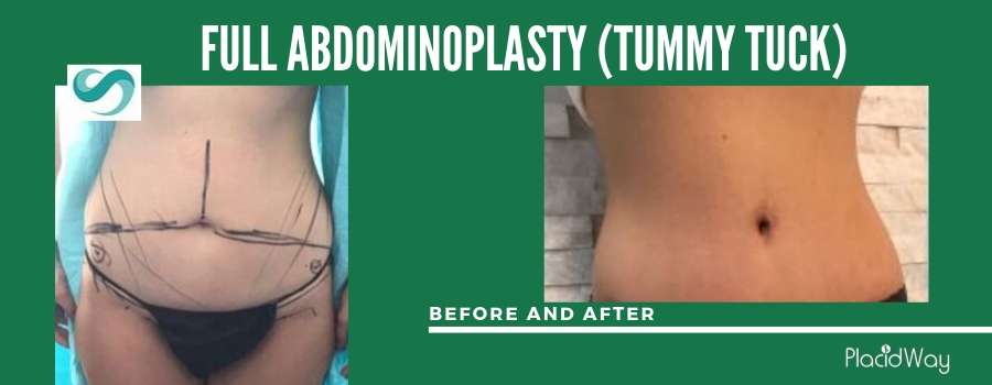 Tummy Tuck Before and After, Antalya, Turkey