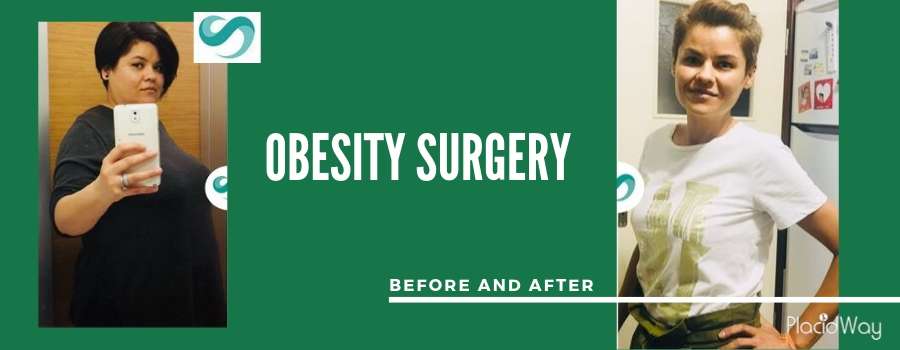 Patient Testimonial Obesity Surgery Before and After, Antalya, Turkey