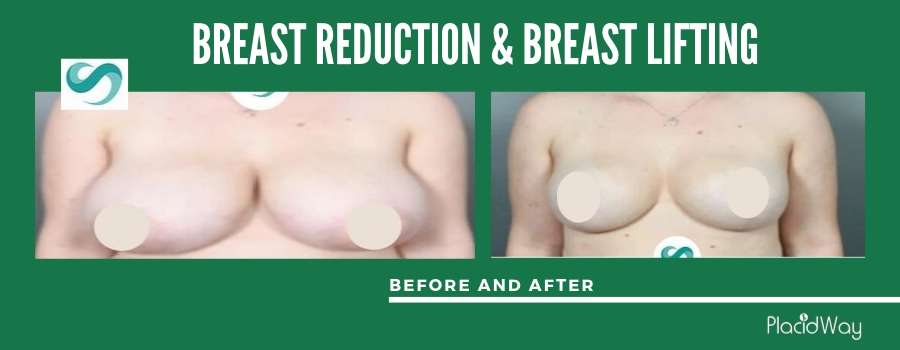 Breast Reduction Before and After, Antalya, Turkey
