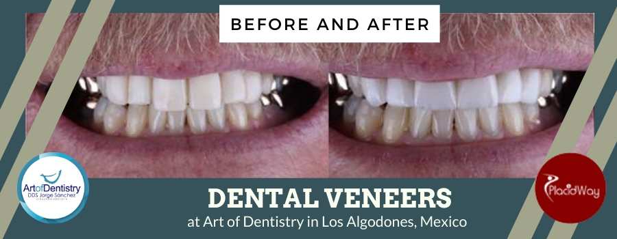 Dental Veneer Treatment in Art of Dentistry, Los Algodones, Mexico