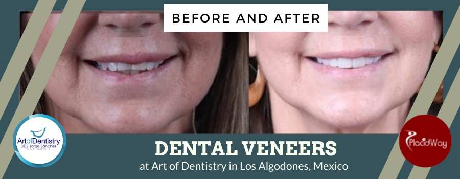 Dental Veneer Before and After in Art of Dentistry, Los Algodones, Mexico