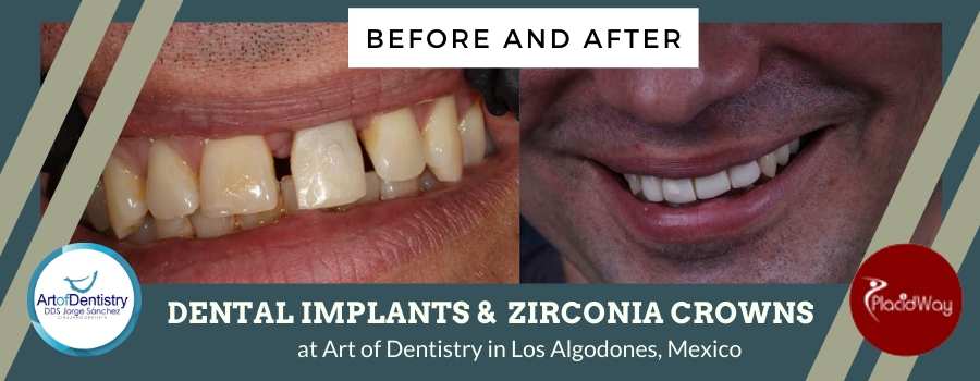 Dental Crowns Before and After in Art of Dentistry, Los Algodones, Mexico