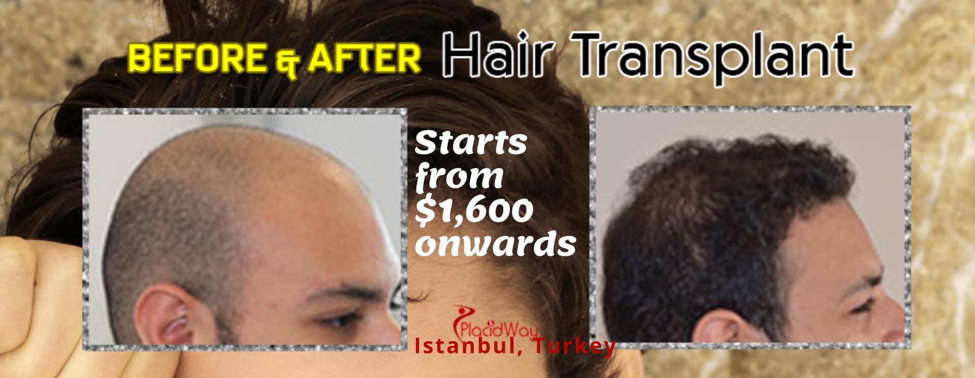 The Best FUE Hair Transplant Package in Istanbul, Turkey
