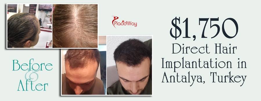 Best DHI Hair Transplantation in Antalya, Turkey Best DHI Hair Transplantation in Antalya, Turkey