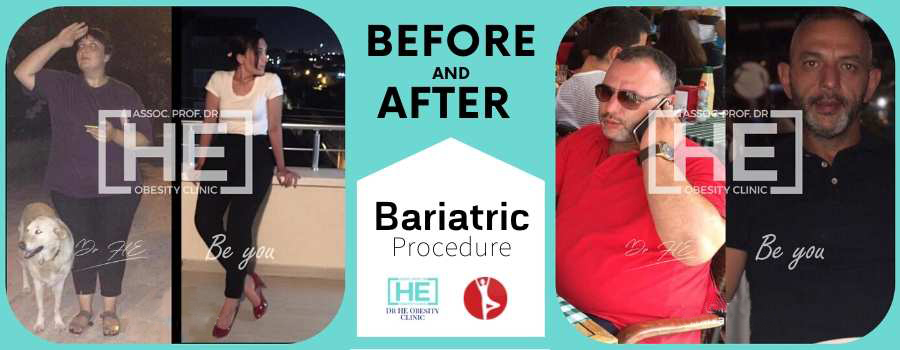 Bariatric Surgery, Istanbul, Turkey