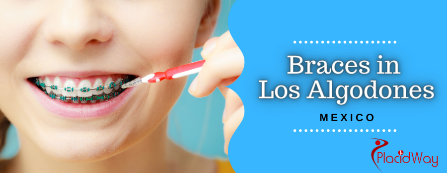 Cost of Braces in Los Algodones, Mexico