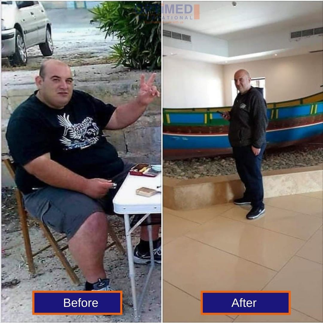 bariatric surgery in istanbul, turkey