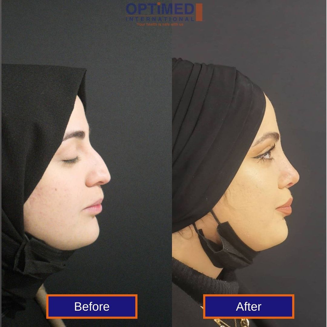 nose surgery in Turkey