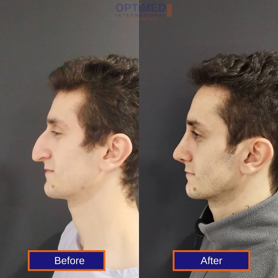 nose plastic surgery in turkey