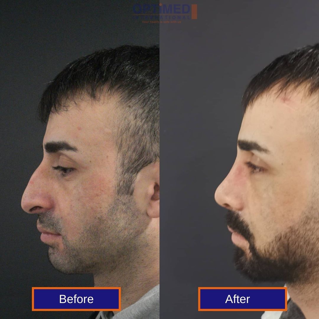 nose surgery in istanbul