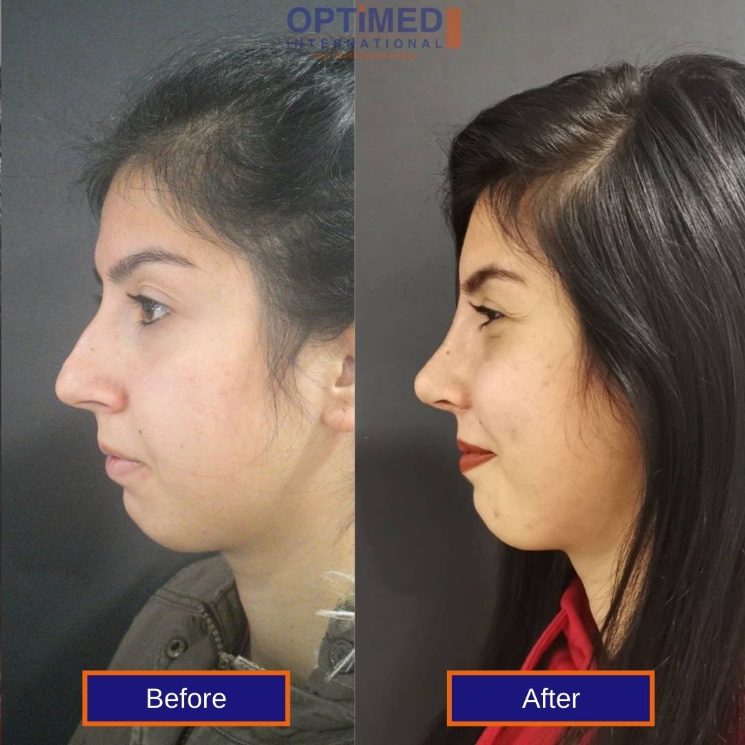 rhinoplasty in turkey