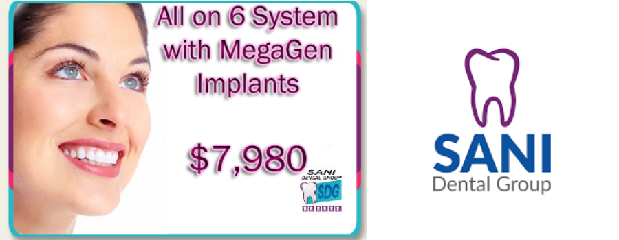 All on 6 Implants Cost in Los Algodones