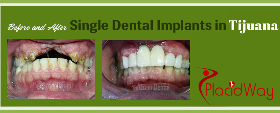 Full Mouth dental Implants Before and After Picture in Tijuana