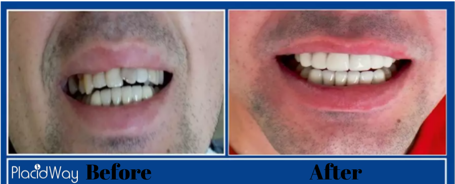dental implant before and after in Turkey