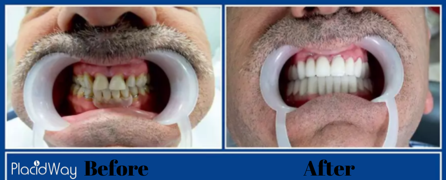 Dental crown before and after in Turkey