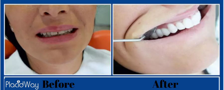 dental veneers before and after in Turkey