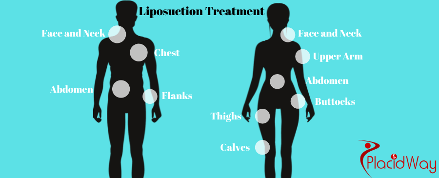 Liposuction treating areas