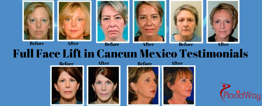 Cancun, Mexico facelift before and after