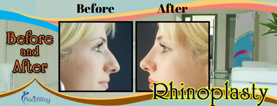 Rhinoplasty before and after in Croatia