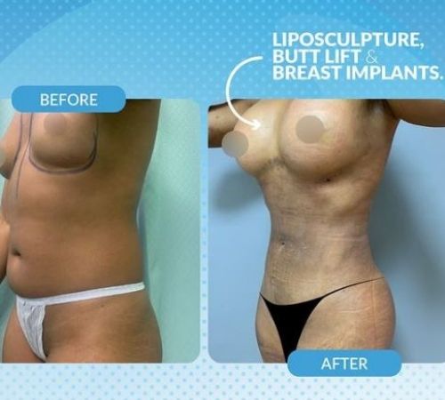 Liposculpture + Butt Lift + Breast Implants Before and After Image