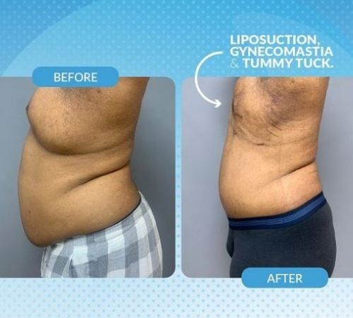 Liposuction + Gynecomastia + Tummy Tuck Before and After Image